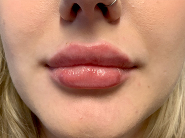 Injectables And Fillers 35