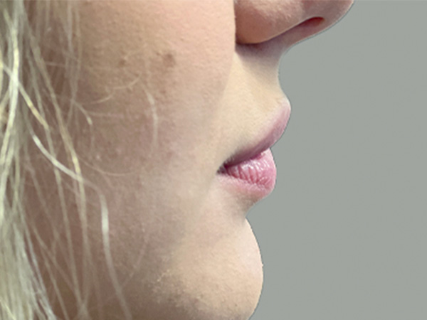 Injectables And Fillers 03