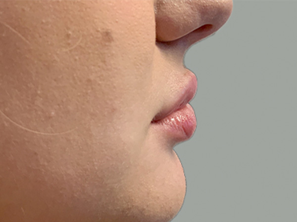 Injectables And Fillers 03