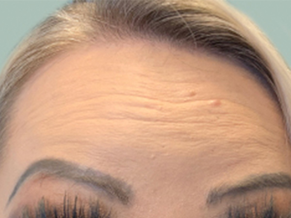 Injectables And Fillers 01