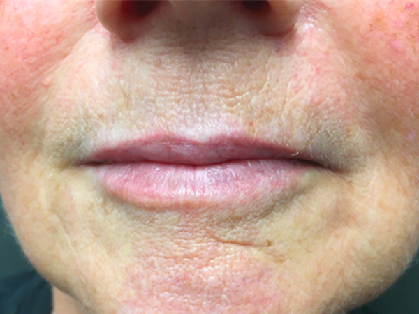 Injectables And Fillers 01