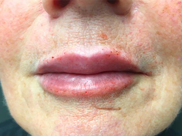 Injectables And Fillers 37