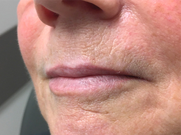 Injectables And Fillers 05