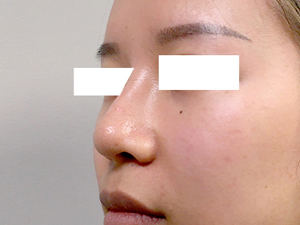 Injectables And Fillers 03