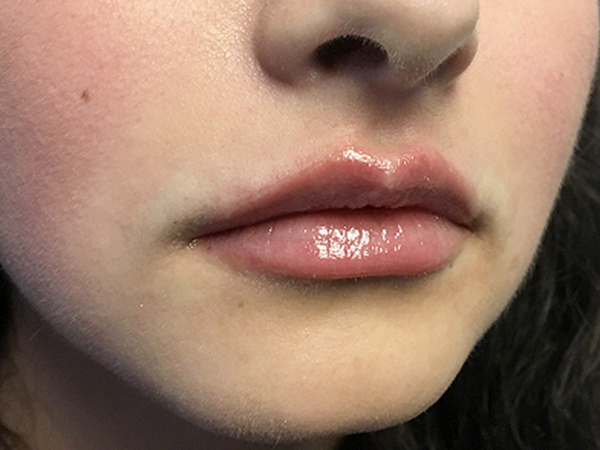 Injectables And Fillers 43