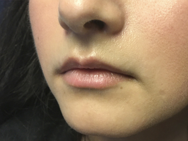 Injectables And Fillers 03