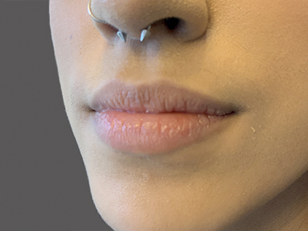 Injectables And Fillers 03