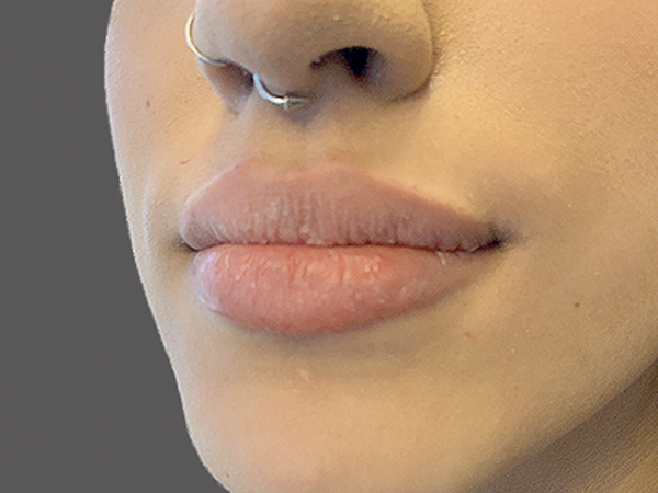 Injectables And Fillers 03