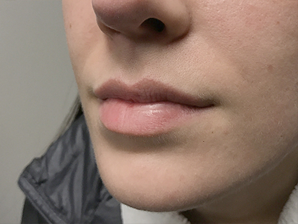 Injectables And Fillers 03