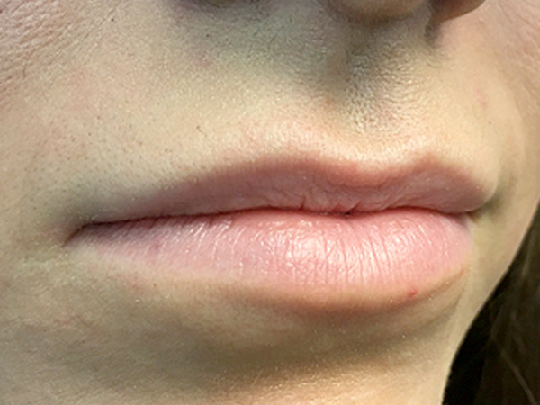 Injectables And Fillers 05