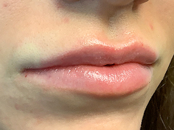 Injectables And Fillers 05