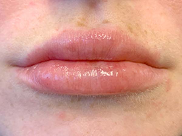 Injectables And Fillers 47