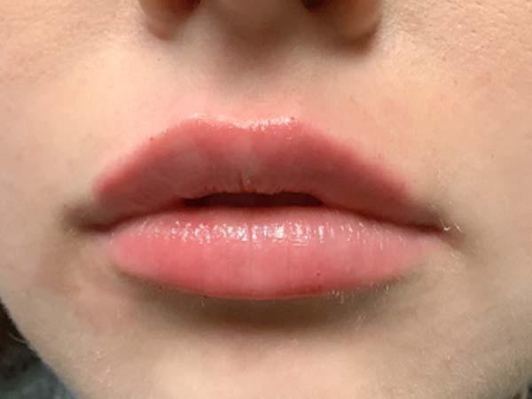 Injectables And Fillers 49