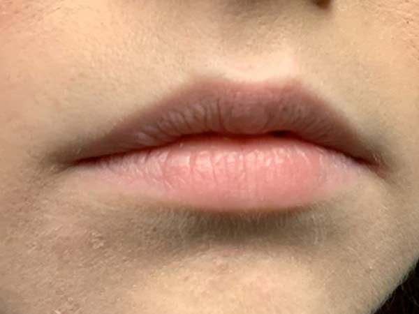 Injectables And Fillers 05