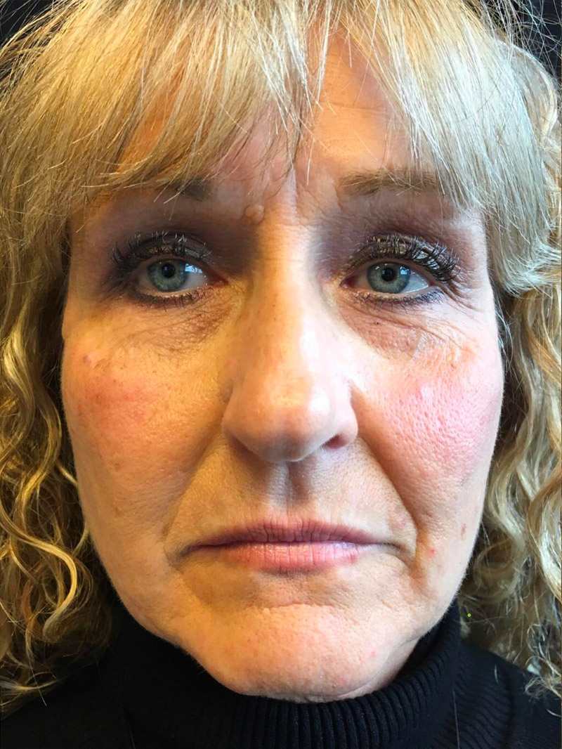 Injectables And Fillers 51