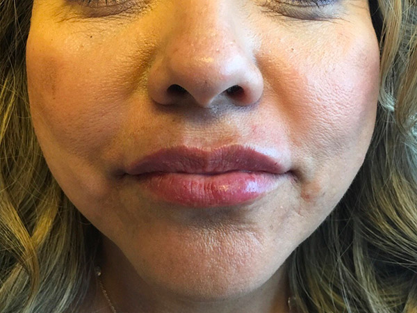 Injectables And Fillers 54