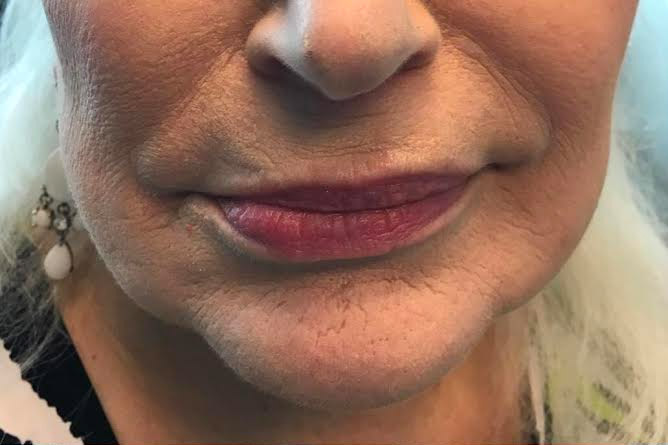 Injectables And Fillers 01