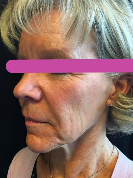 Injectables And Fillers 01