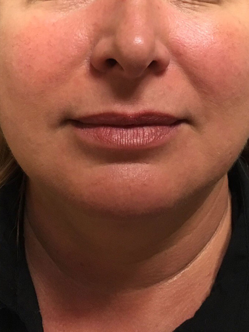 Injectables And Fillers 01