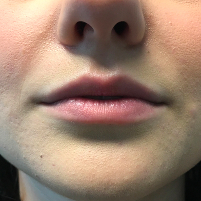 Injectables And Fillers 01