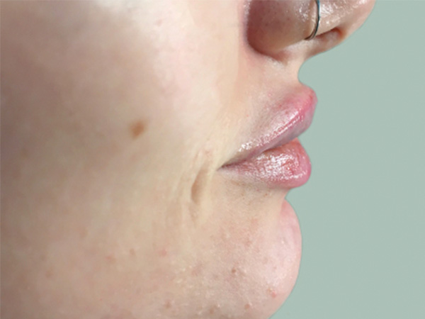 Injectables And Fillers 03