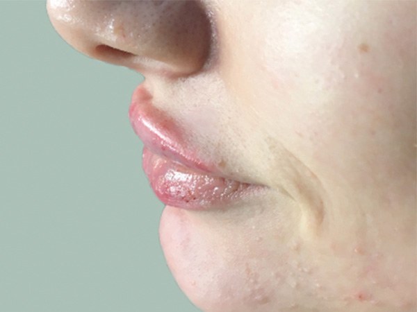 Injectables And Fillers 05