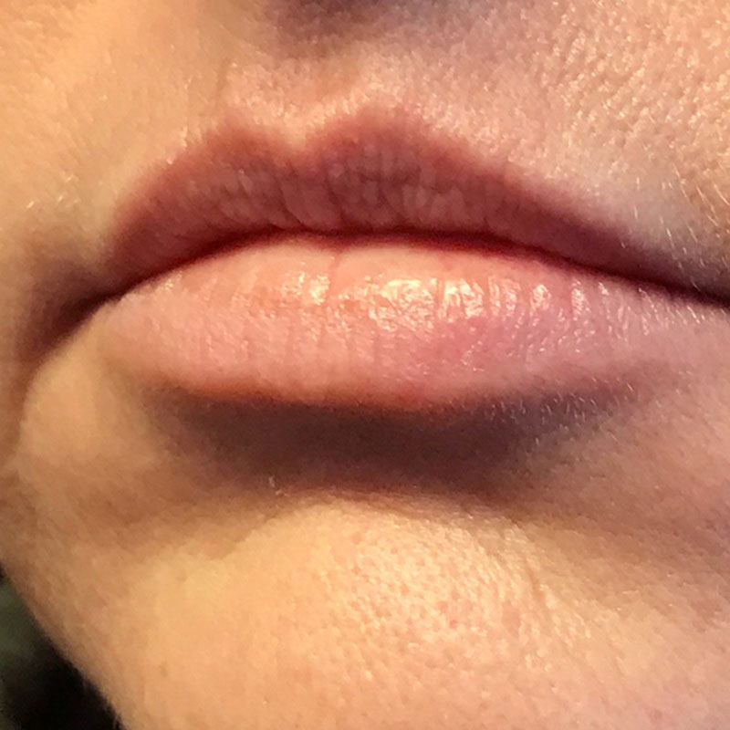 Injectables And Fillers 01