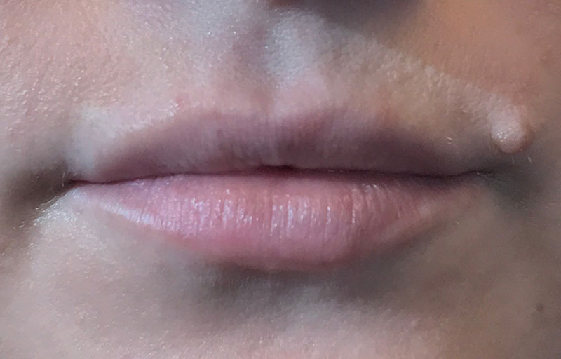 Injectables And Fillers 01