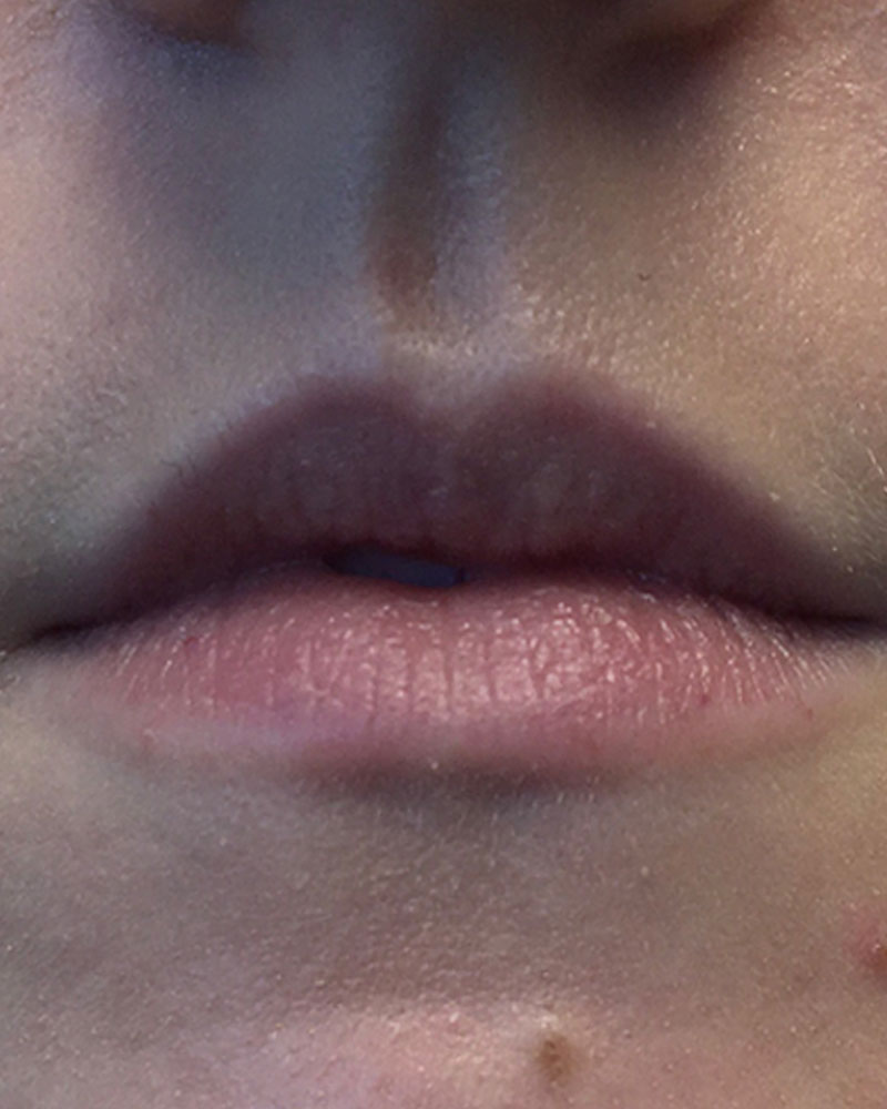 Injectables And Fillers 01