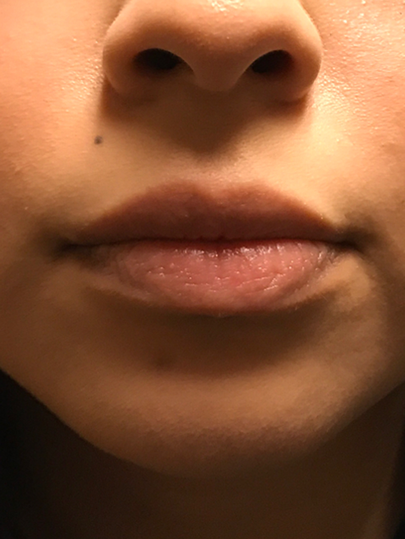 Injectables And Fillers 01