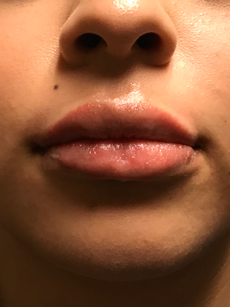 Injectables And Fillers 68