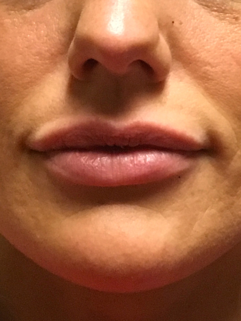 Injectables And Fillers 01