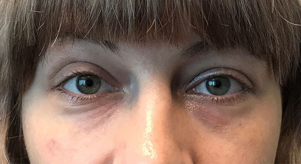 Injectables And Fillers 75