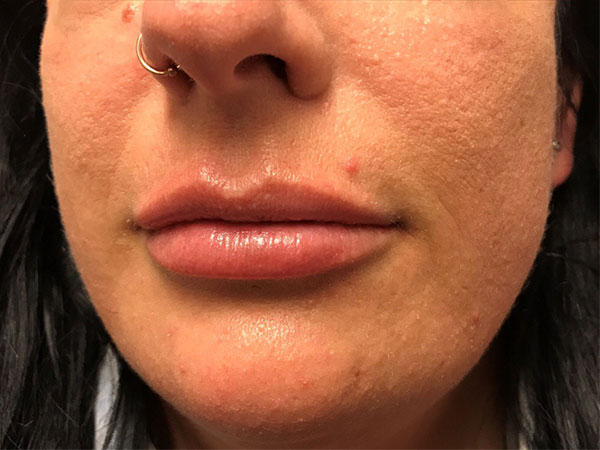 Injectables And Fillers 03