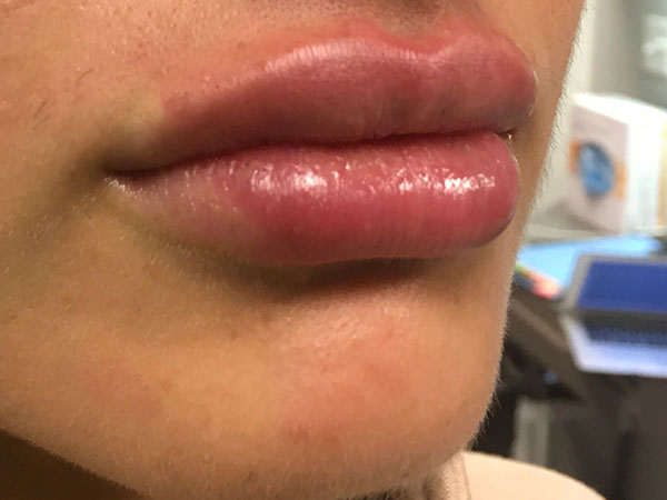 Injectables And Fillers 79