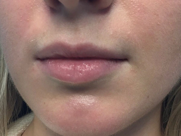 Injectables And Fillers 03