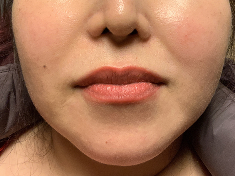 Injectables And Fillers 01