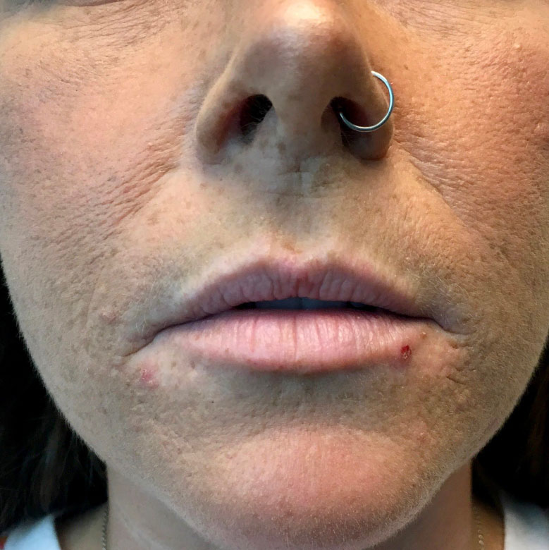 Injectables And Fillers 01