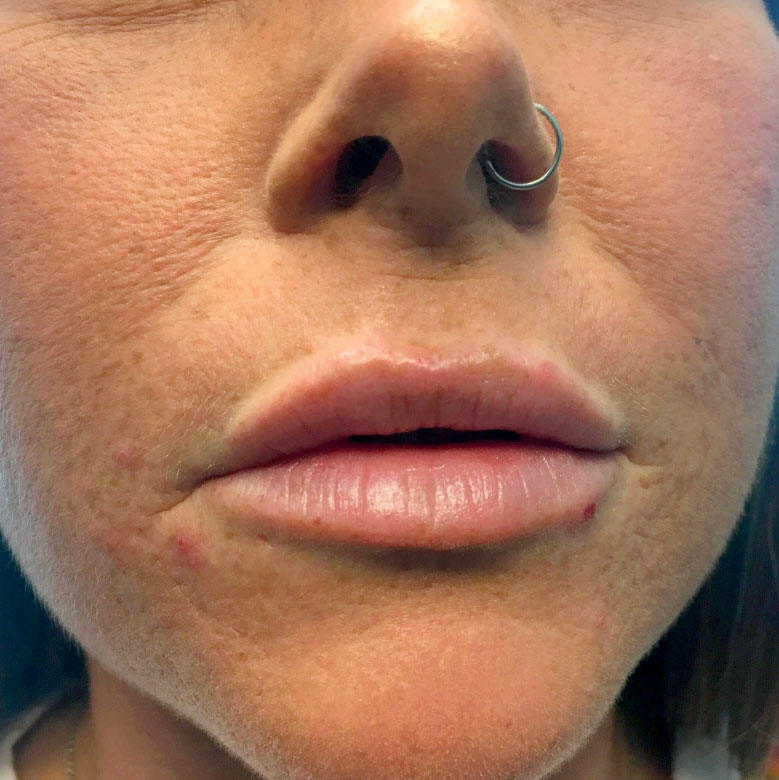 Injectables And Fillers 84