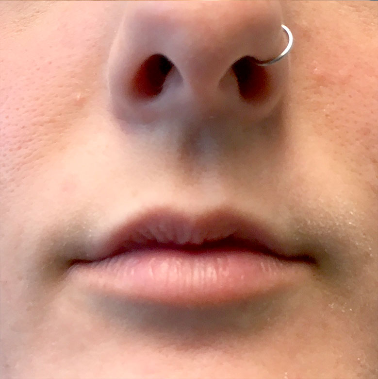 Injectables And Fillers 01