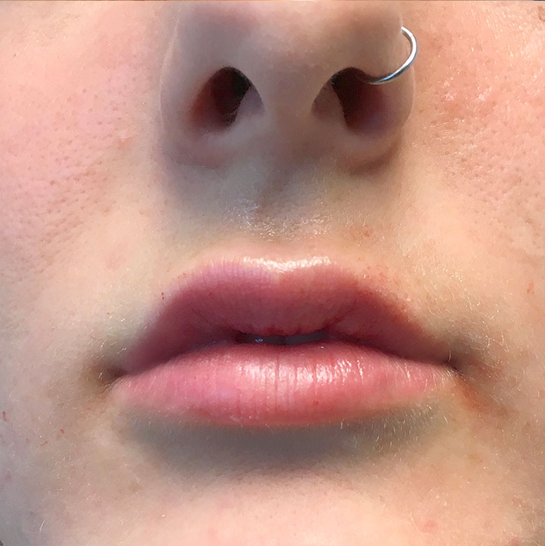 Injectables And Fillers 85