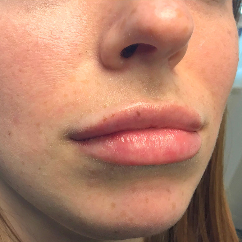 Injectables And Fillers 86