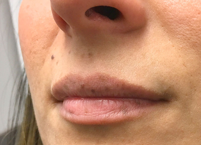 Injectables And Fillers 03