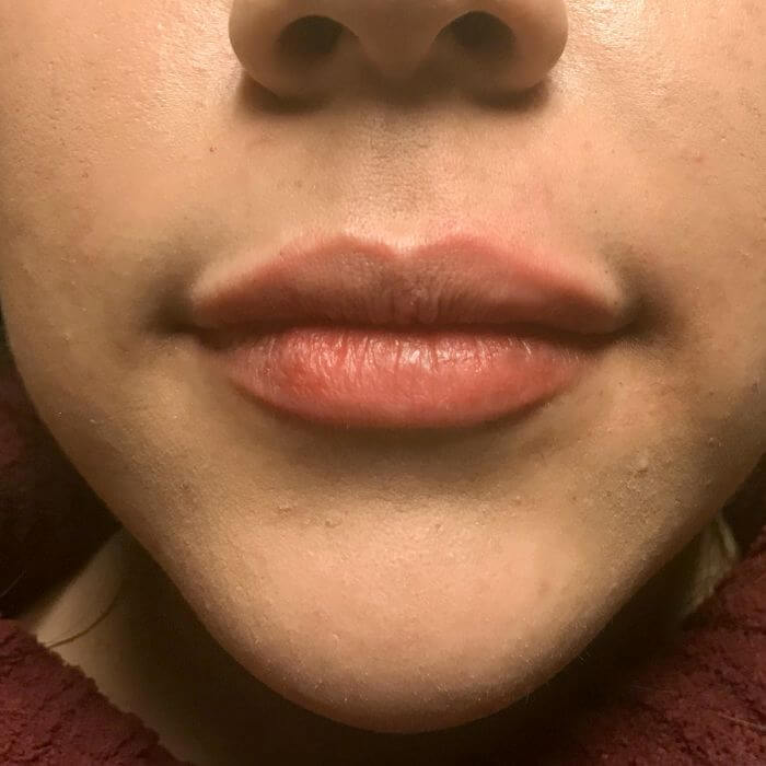 Injectables And Fillers 95