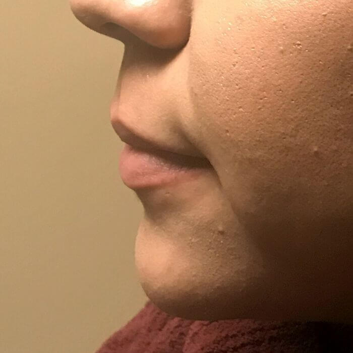 Injectables And Fillers 03