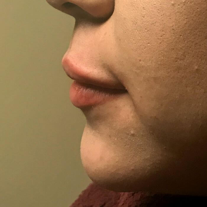 Injectables And Fillers 03