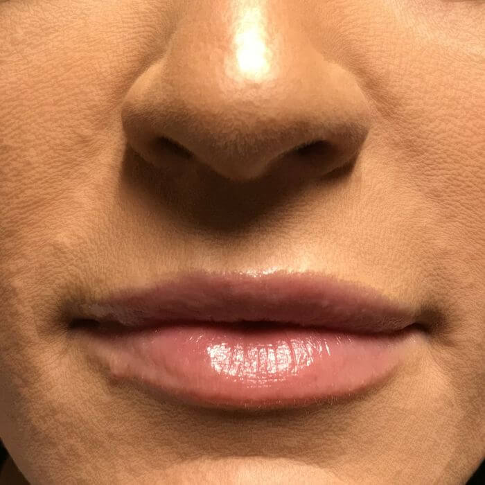 Injectables And Fillers 01