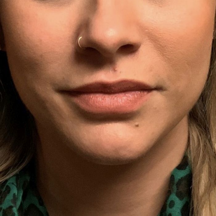 Injectables And Fillers 01