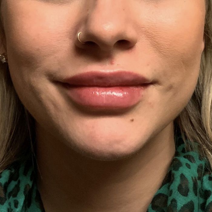 Injectables And Fillers 97