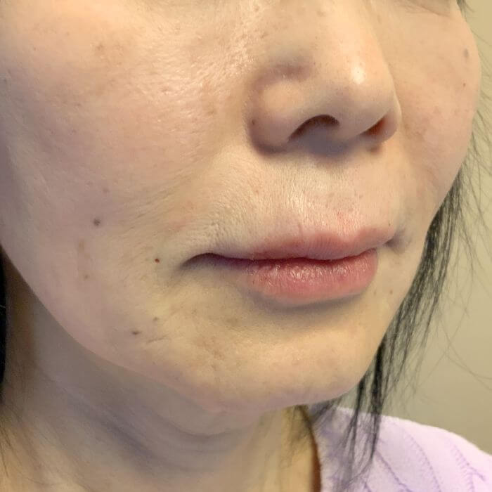 Injectables And Fillers 03